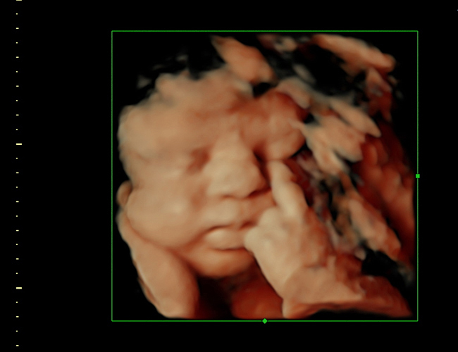 3D ultrasound image at 33 weeks